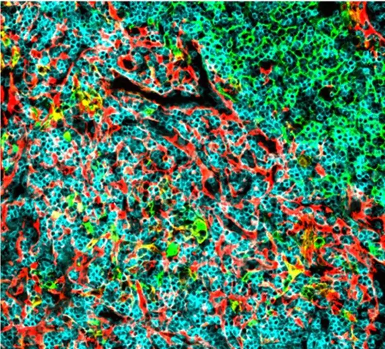 Identifican dos mol&eacute;culas del organismo que podr&iacute;an ayudar a frenar el crecimiento de un tipo de leucemia muy agresiva