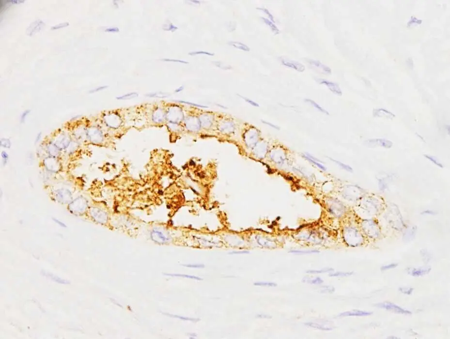 Investigadores espa&ntilde;oles crean un prototipo de test para detectar c&aacute;ncer de p&aacute;ncreas 'en minutos' con muestras de sangre