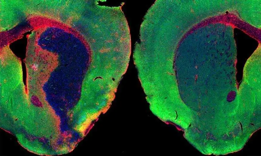 Un estudio liderado por el CSIC revela que una mol&eacute;cula del organismo reduce inflamaci&oacute;n y da&ntilde;o cerebral tras ictus