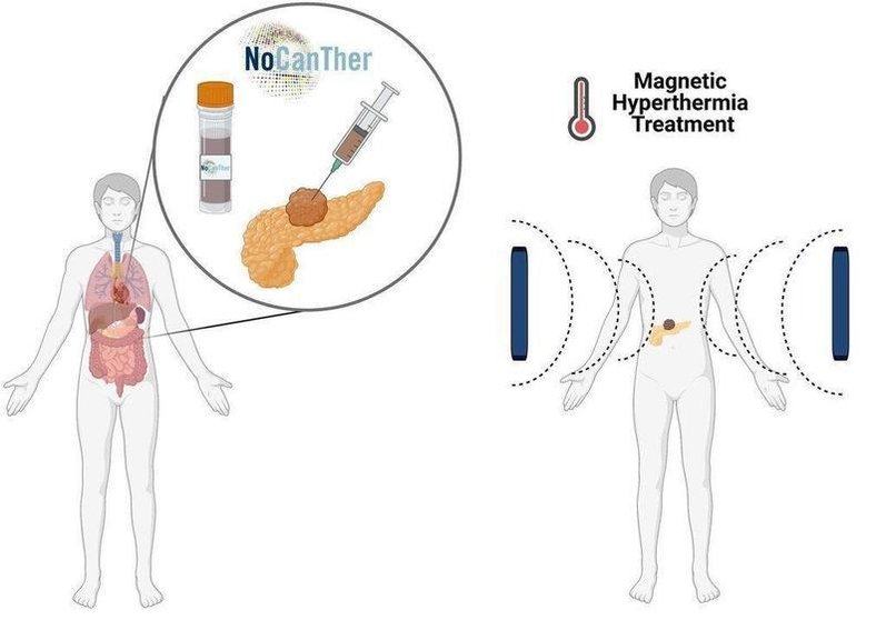  El estudio entra en su última fase para el tratamiento del cáncer de páncreas localmente avanzado mediante el uso de nanopartículas magnéticas. // EP 