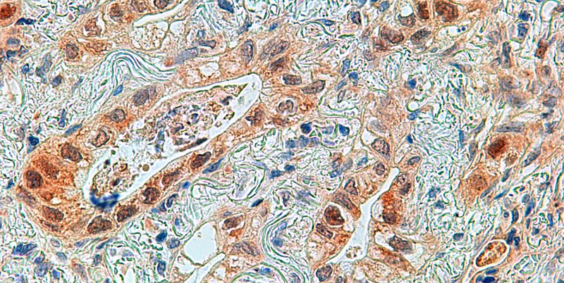 <p> Imagen al microscopio de un adenocarcinoma de pulmón con la proteína ERK5 marcada en marrón en las células tumorales. Cáncer de pulmón. - HOSPITAL CLÍNICO UNIVERSITARIO DE SALAMANCA/CSIC </p>