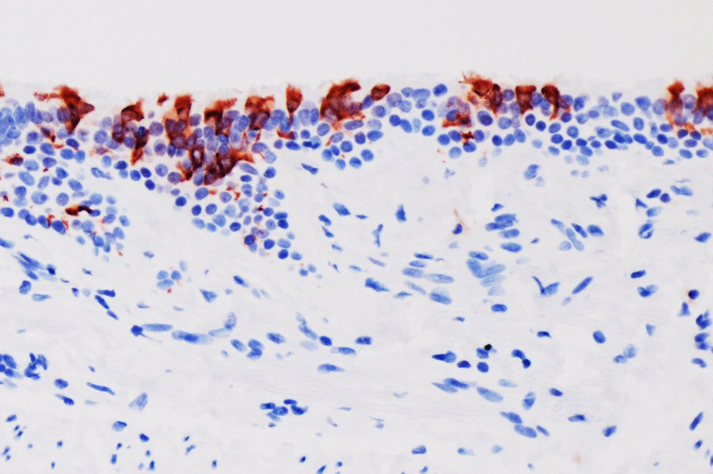 <p> La variante omicrón del SARS-CoV-2 (en rojo) infectando tejidos de bronquios humanos. - UNIVERSIDAD DE HONG KONG </p>