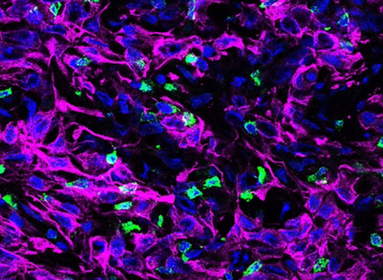 <p> Un corte transversal de tejido tumoral pancreático de ratón. Estas células cancerosas (teñidas de púrpura) carecen de una proteína llamada KRT19 en su capa externa que forma parte de un complejo que desactiva el movimiento de las células T (verde). - ZHIKAI WANG/FEARON LAB/CSHL, 2022 </p>