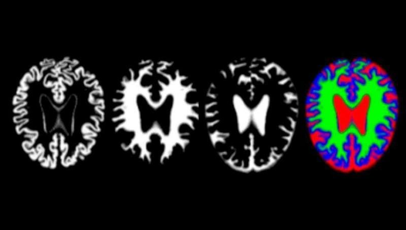 <p> imágenes de resonancia de cerebros con alzhéimer/ Imagen: Sinc </p>