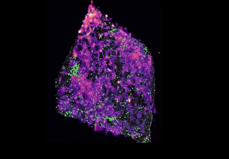 <p> Tumor de glioma humano con una mutación que muestra grupos de células T en verde y cuyos puntos rosa representan concentraciones del metabolito D-2HG. - HARVARD MEDICAL SCHOOL - URV </p>