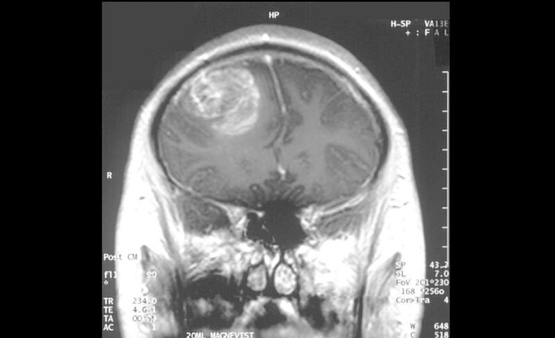  MRI of a glioblastoma – CC 2.5. Christaras A 