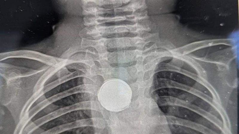  Radiografía del niño estadounidense que se tragó una pila 