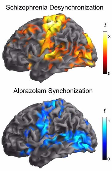 Imagen que muestra la similitud entre las áreas afectadas en el cerebro de una persona con esquizofrenia (figura superior) y las áreas donde se concentran las neuronas estudiadas (figura inferior) - HOSPITAL DEL MAR 