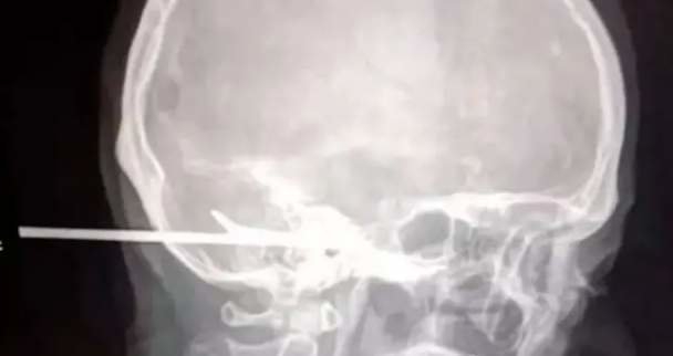  Radiografía del cráneo atravesado con un arpón - 20 minutos 