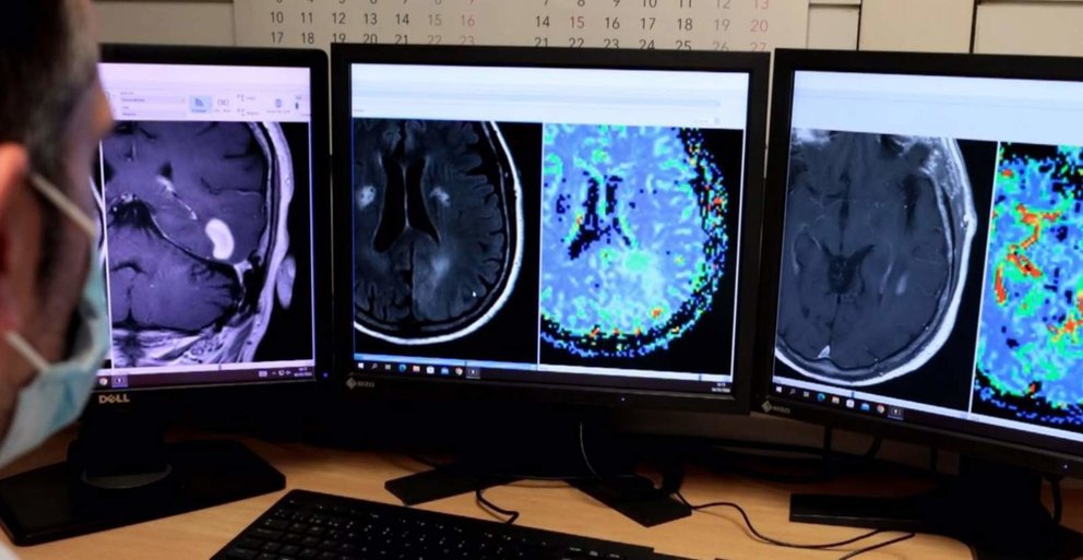  Imágenes de resonancia magnética de cerebro en el Hospital Universitari de Bellvitge (HUB), que ha colaborado con los investigadores del Vall d'Hebron Institut d'Oncologia (VHIO) - VHIO<br>La aplicación acierta el 78% de los diagnósticos<br><br>BARCELONA, 11 Mar. (EUROPA PRESS) -<br><br>Investigadores del Vall d'Hebron Institut d'Oncologia (VHIO), con la colaboración de la Unidad de Neuroradiología del Hospital Universitari de Bellvitge (HUB), han desarrollado una herramienta basada en inteligencia artificial (IA) para mejorar el diagnóstico diferencial de tumores cerebrales.<br><br>Se trata de la aplicación DISCERN (Diagnosi In Susceptibility Contrast Enhancing Regions for Neuroncology) que tiene potencial para diferenciar tres tipos de tumor cerebral mediante resonancia magnética estándar, según la investigación 