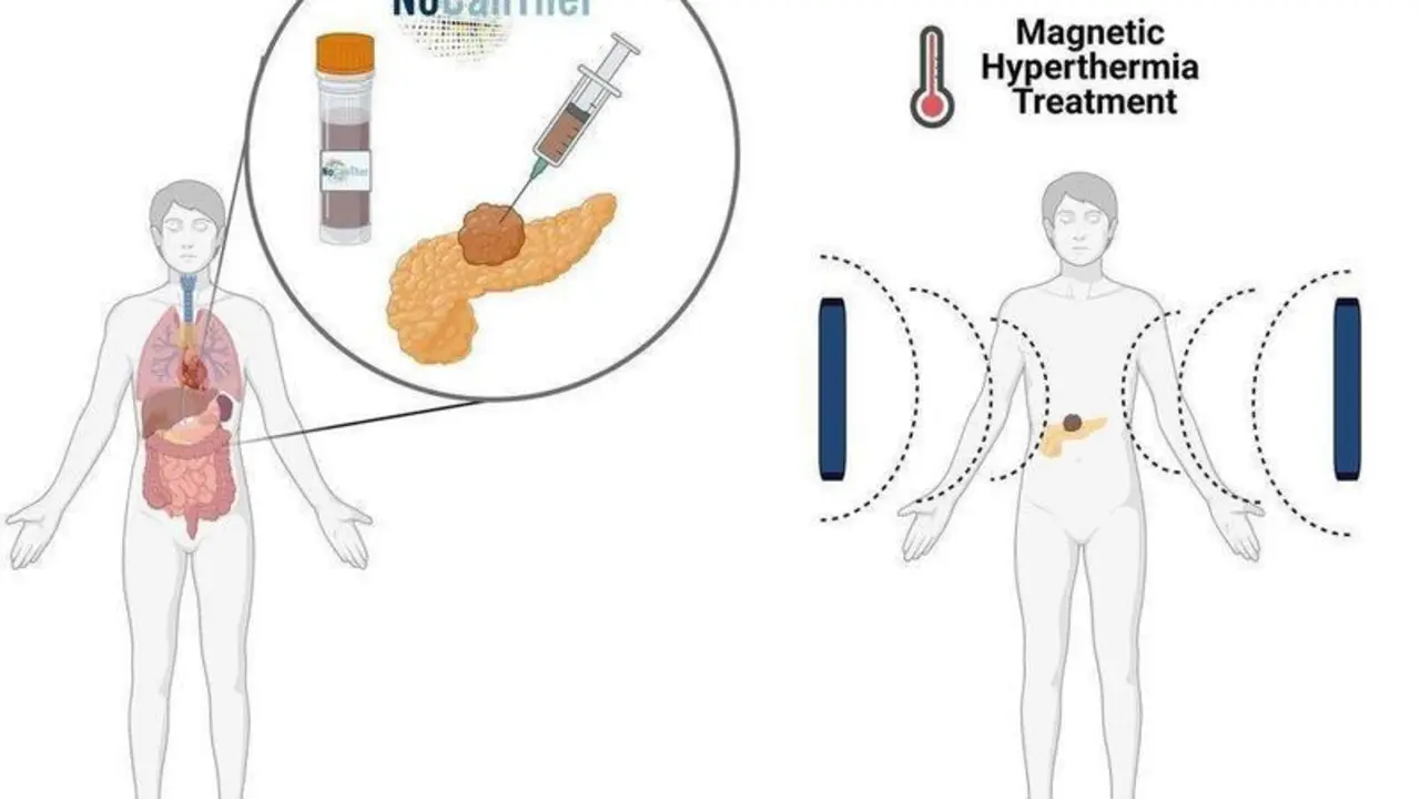  El estudio entra en su &uacute;ltima fase para el tratamiento del c&aacute;ncer de p&aacute;ncreas localmente avanzado mediante el uso de nanopart&iacute;culas magn&eacute;ticas. // EP 