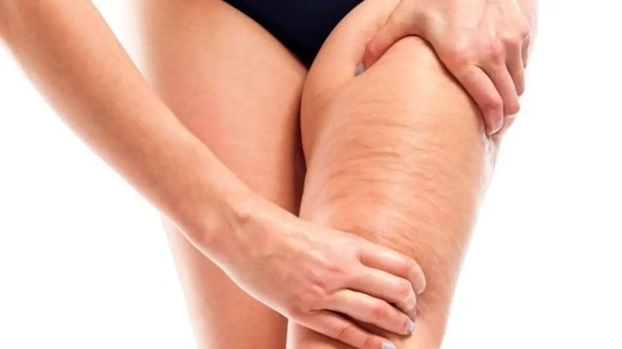  Celulitis - Pinterest 