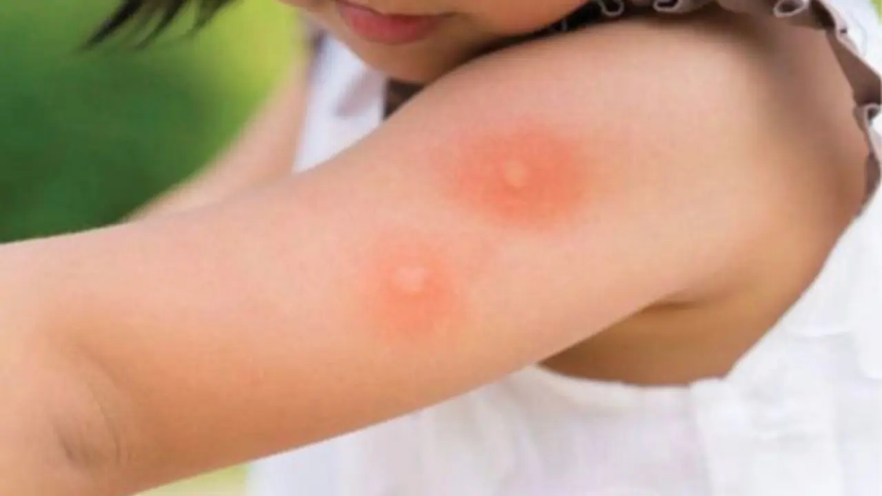  Picaduras de mosquitos. Pinterest. 