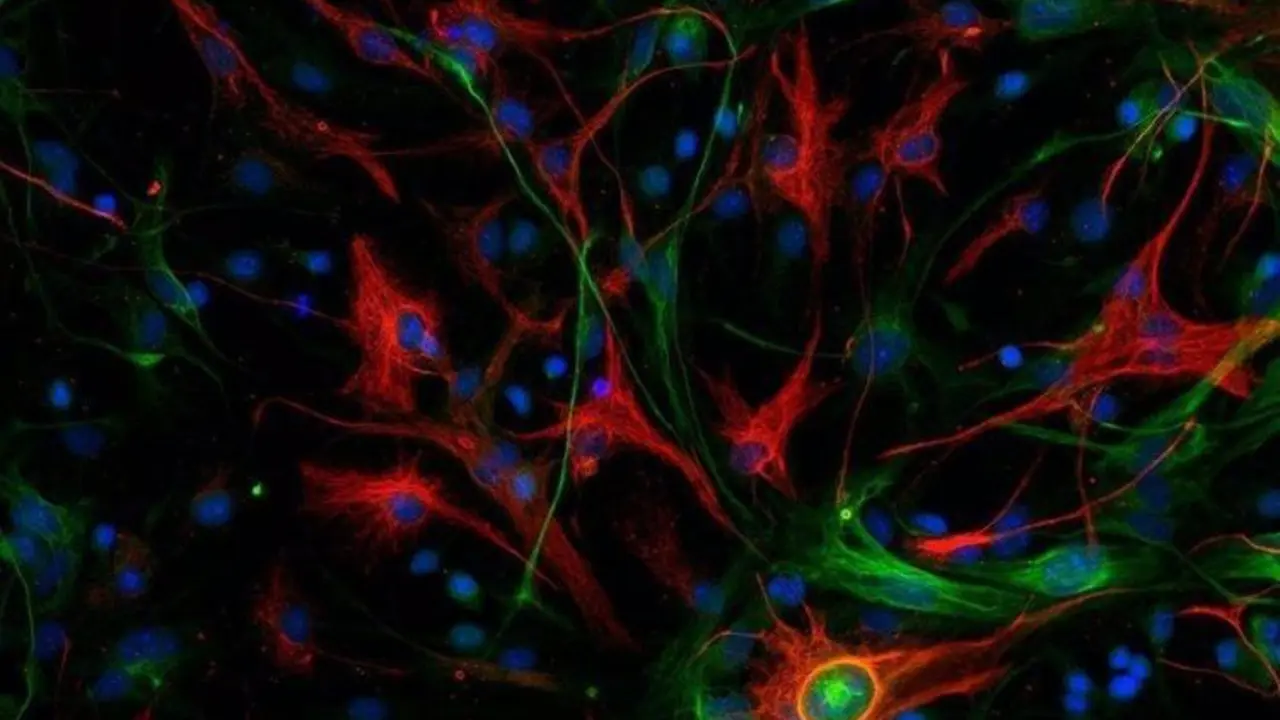  Glioblastoma mesenquimal de rat&oacute;n con las c&eacute;lulas madre marcadas en color verde y las c&eacute;lulas diferenciadas en rojo. - CNIO-EuropaPress 
