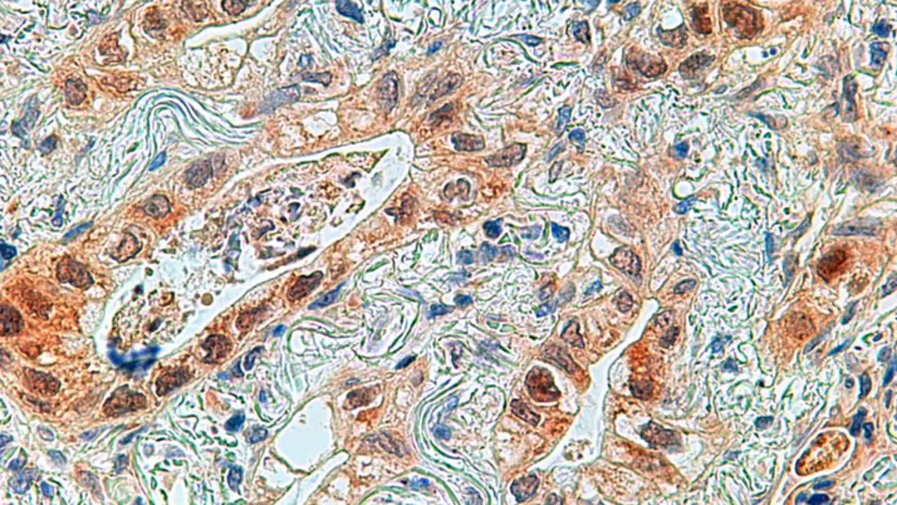 <p> Imagen al microscopio de un adenocarcinoma de pulm&oacute;n con la prote&iacute;na ERK5 marcada en marr&oacute;n en las c&eacute;lulas tumorales. C&aacute;ncer de pulm&oacute;n. - HOSPITAL CL&Iacute;NICO UNIVERSITARIO DE SALAMANCA/CSIC </p>