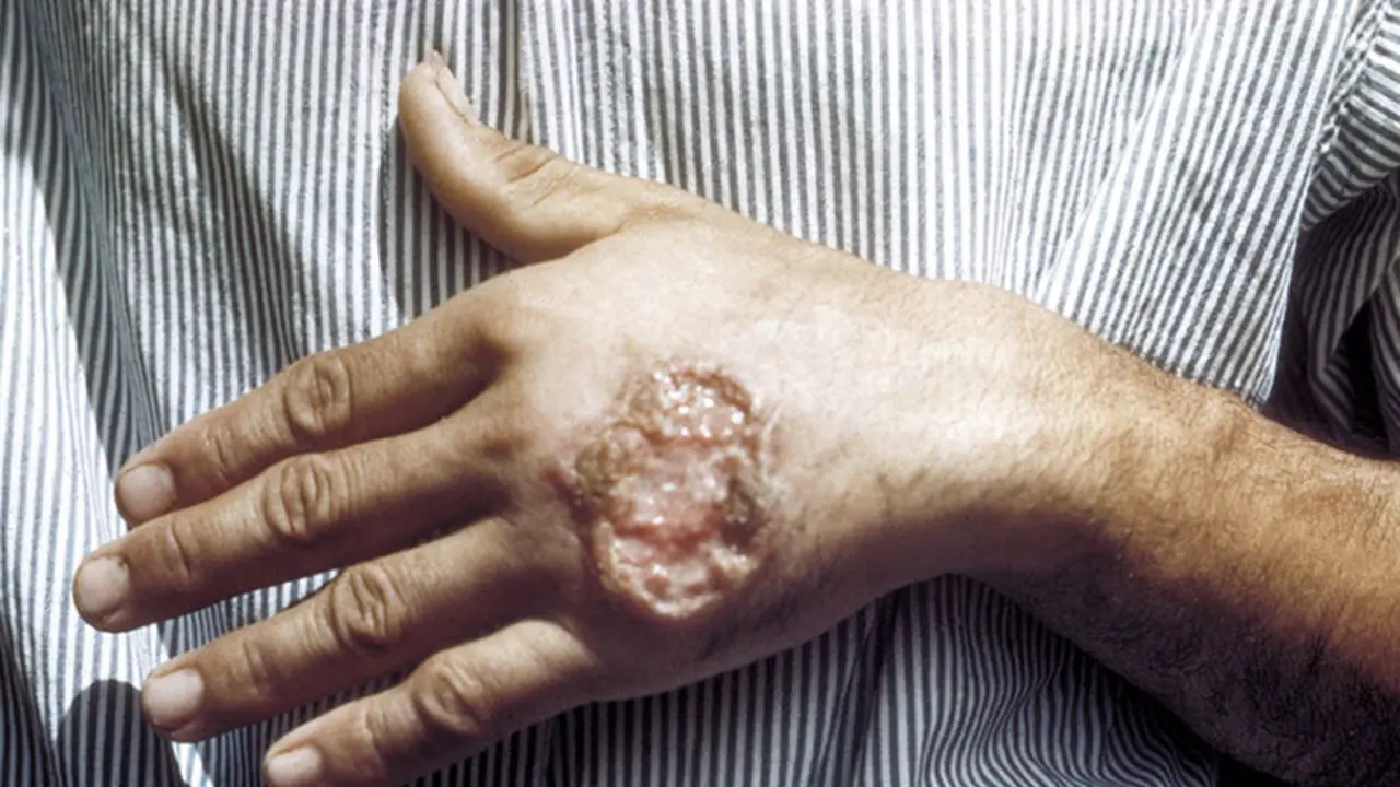 <p> Archivo - Leishmaniasis - CREATIVE COMMONS - Archivo </p>