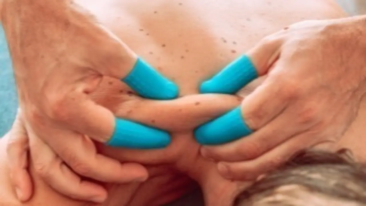 <p> Thimblex, una t&eacute;cnica innovadora para el tratado de lesiones. </p>