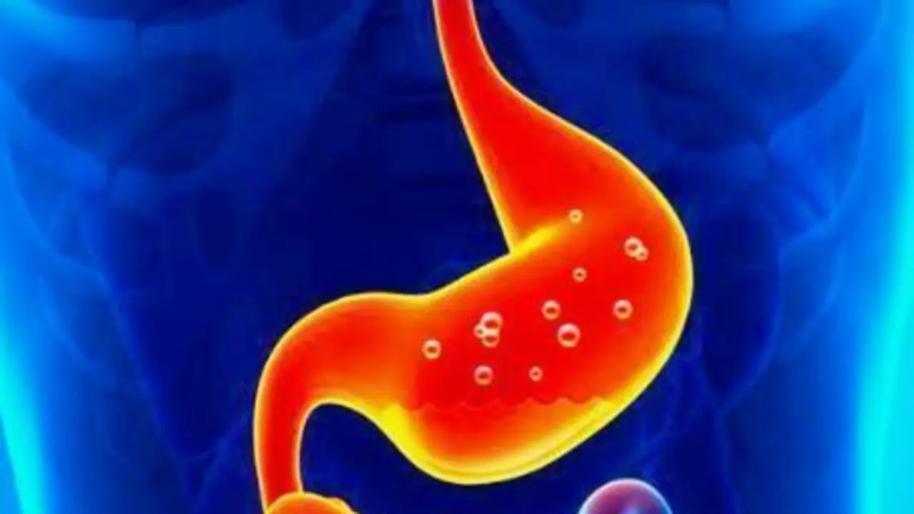 <p> ardor estomacal </p>