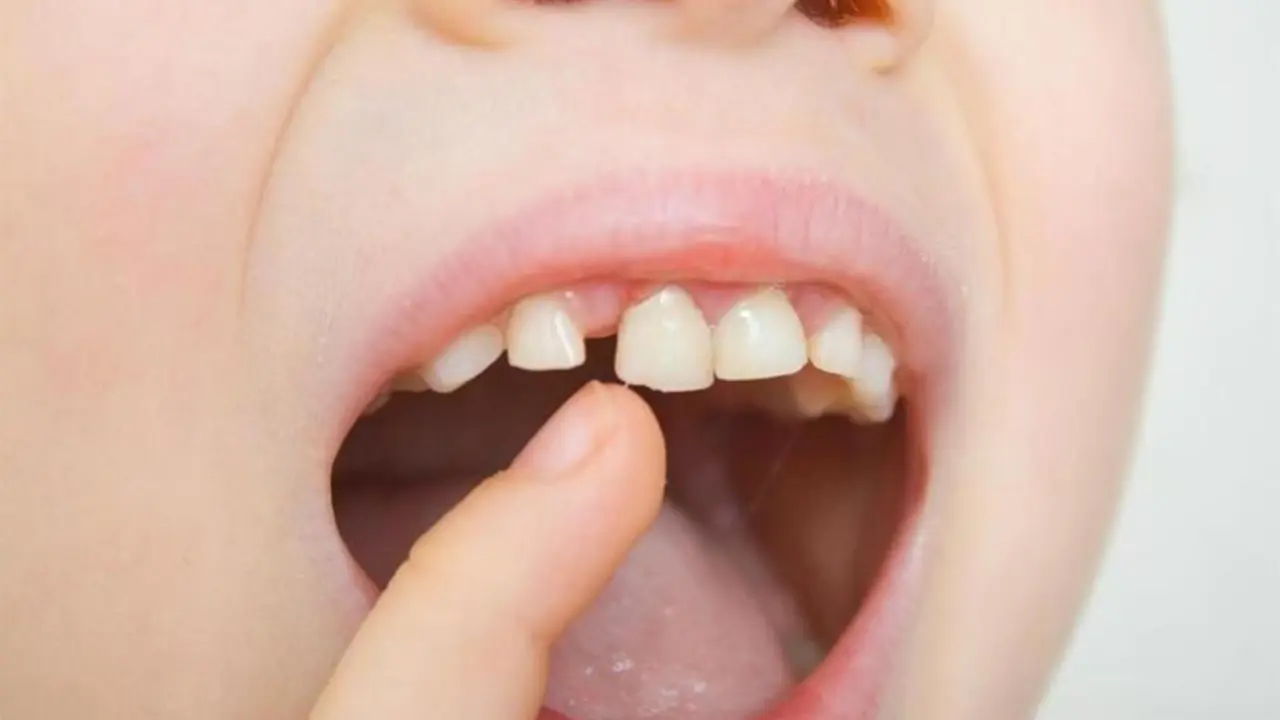 <p> Dientes de leche, dientes de ni&ntilde;o, boca de ni&ntilde;o - CEDIDA - COMPROMISO Y SEGURIDAD DENTAL </p>