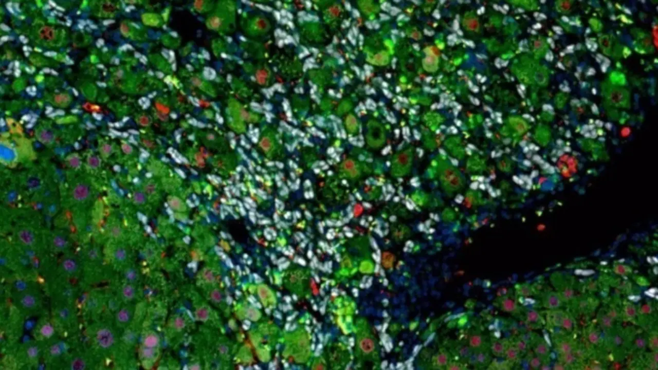 <p> La cirrosis hep&aacute;tica tiene un mecanismo que por fin se ha descubierto. </p>