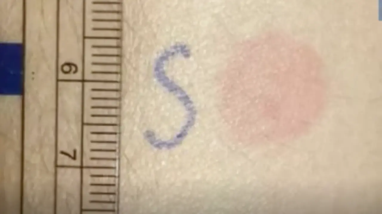 <p> Test cut&aacute;neo para dosis de refuerzo. Fuente: Twitter @YbpCph </p>