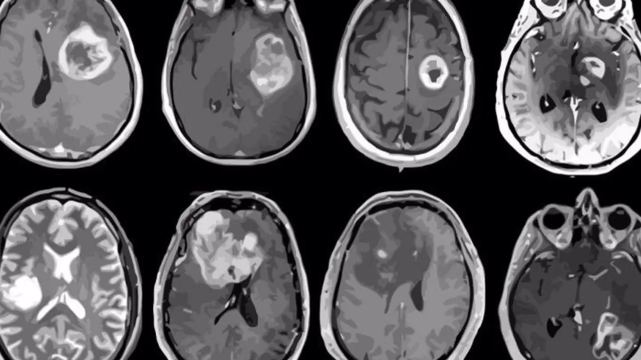 <p> Archivo - Glioblastoma, tumor cerebral agresivo mapeado en detalle gen&eacute;tico y molecular. - ALBERT H. KIM - Archivo </p>