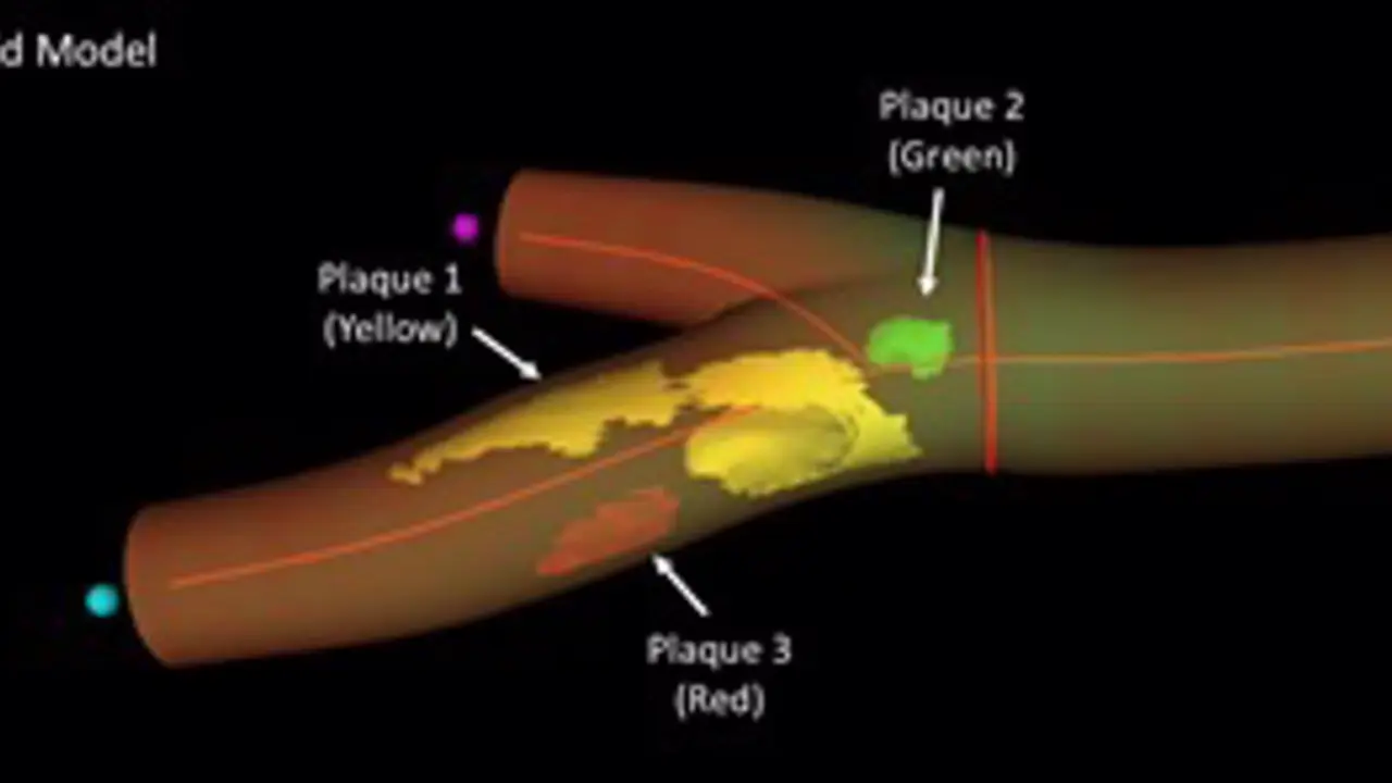 <p> Modelo 3D de la arteria femoral derecha que se obtiene con la imagen 3D real donde se representa la localizaci&oacute;n, n&uacute;mero y extensi&oacute;n de las distintas placas de aterosclerosis, hasta 3 placas en el caso de este paciente (flechas). - CNIC </p>