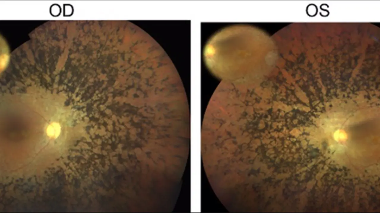 <p> Fondo de ojo del paciente con retinitis pigmentosa en el que se ha identificado la mutaci&oacute;n en el gen CFAP20. OD=ojo derecho, OS=ojo izquierdo. Fuente: Europa Press </p>