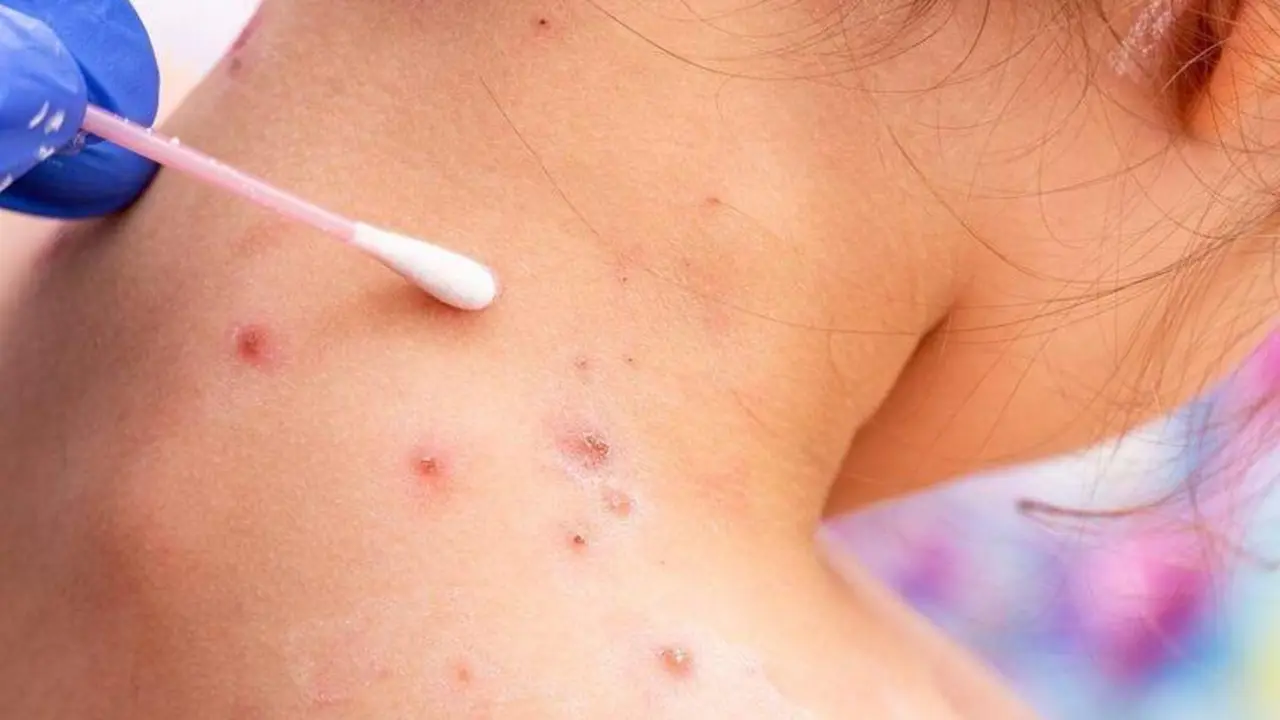 <p> Mujer con Viruela del Mono </p>