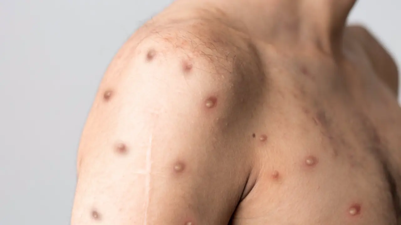 <p> Viruela del mono. - ISTOCK </p>