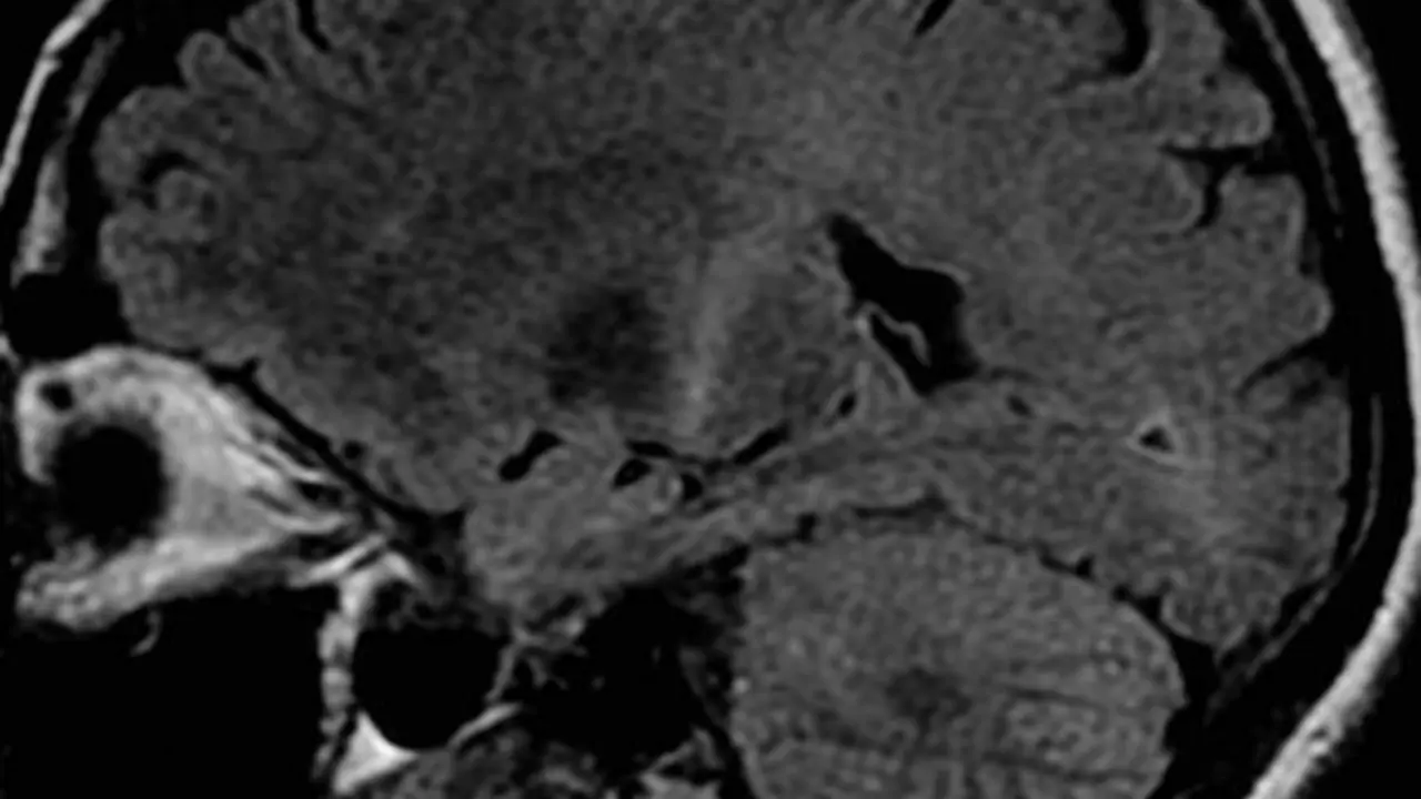 <p> Cerebro afectado por la ELA </p>