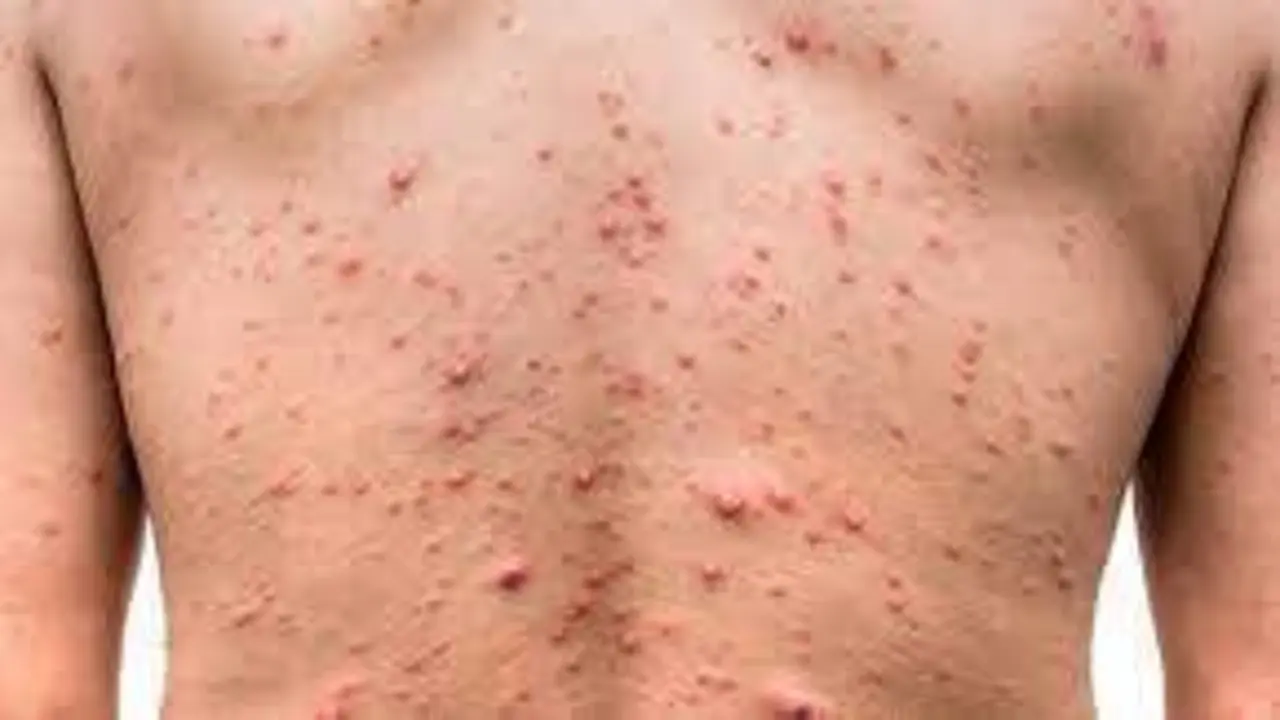 <p> Espalda afectada por la viruela del mono </p>