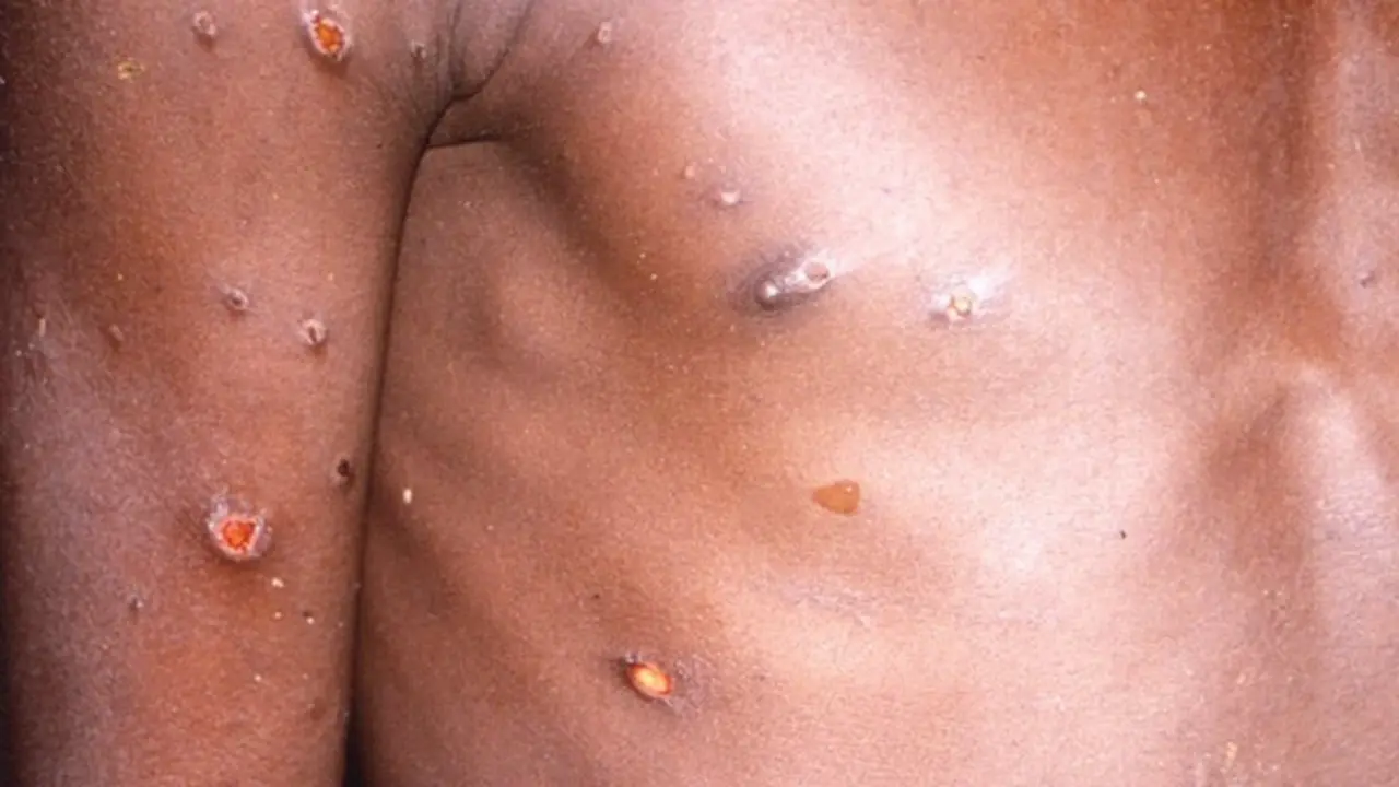 <p> Archivo - La viruela del mono produce lesiones cut&aacute;neas, fiebre y dolor corporal en las personas afectadas por el virus. - CDC - Archivo </p>