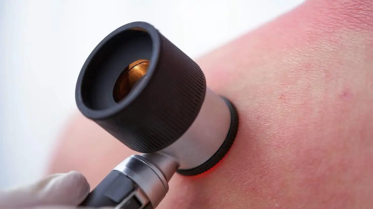 <p> Dermatitis. </p>