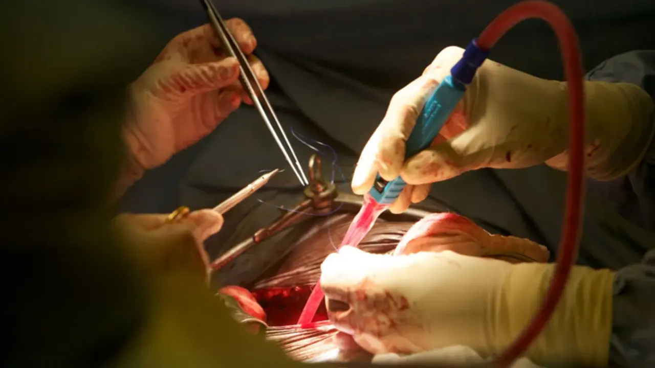 <p> Operaci&oacute;n de Agust&iacute; Rovira </p>