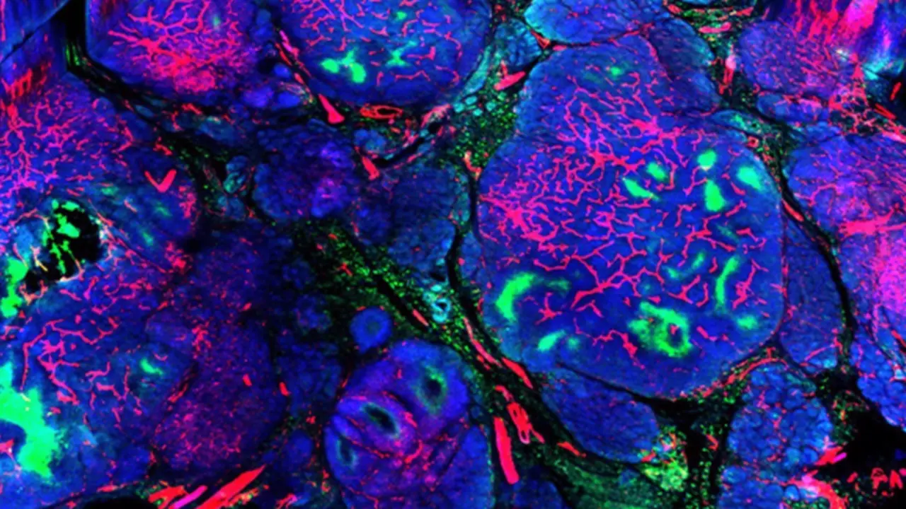  Mama con presencia de c&eacute;lulas cancer&iacute;genas HER2 positiva./ - NCI 