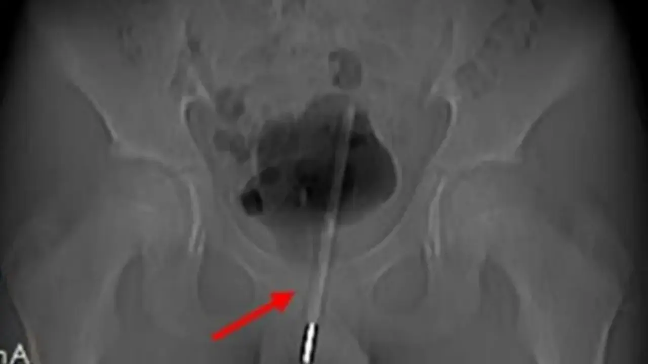  El term&oacute;metro atascado dentro del ni&ntilde;o 