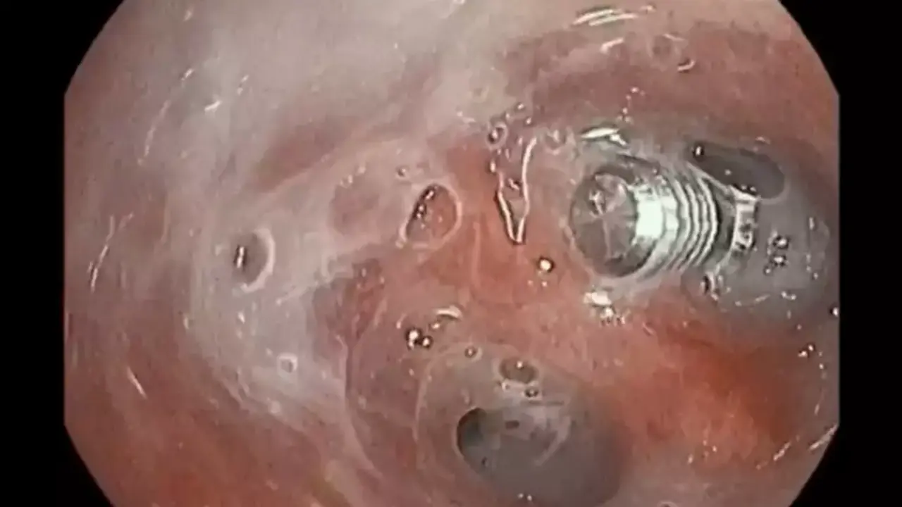  Tornillo en bronquios - Foto del Hospital Vithas 