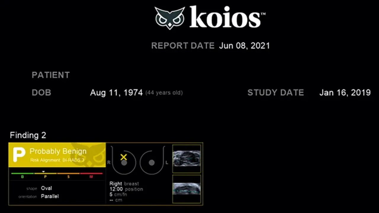  Un estudio confirma la eficacia de la inteligencia artificial en el diagn&oacute;stico del c&aacute;ncer de mama - DEXEUS MUJER 