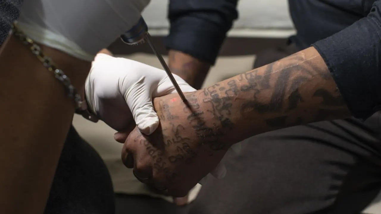  Archivo - Borrado de tatuajes de un miembro de una mara, Barrio 18, en El Salvador - GILES CAMPBELL / ZUMA PRESS / CONTACTOPHOTO 