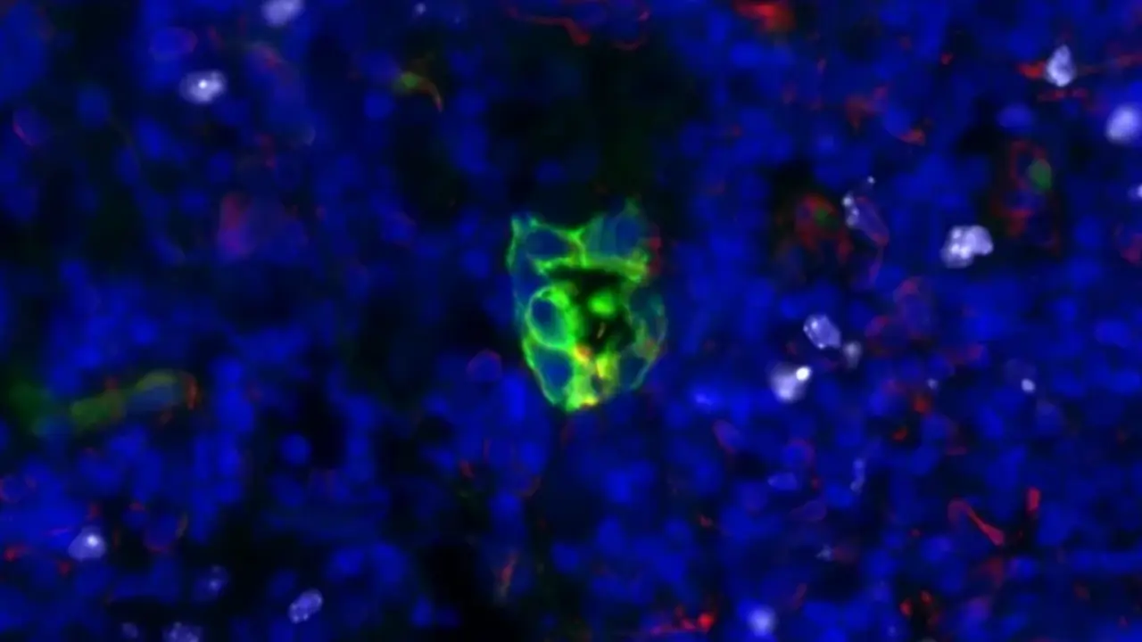 Un grupo quiescente de c&eacute;lulas tumorales de adenocarcinoma de pulm&oacute;n de un ganglio linf&aacute;tico de un paciente muestra una baja expresi&oacute;n de STING. Imagen cortes&iacute;a del laboratorio Massagu&eacute;. 