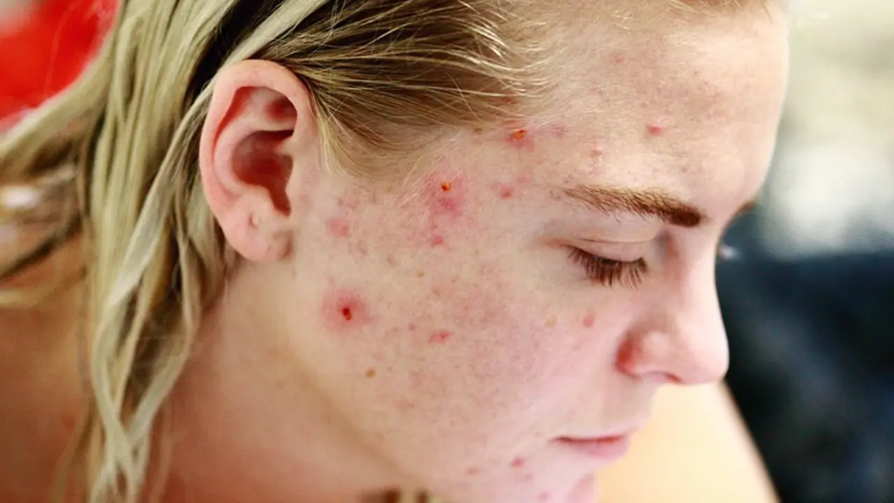  Archivo - Acn&eacute; - SEPEAP - Archivo 