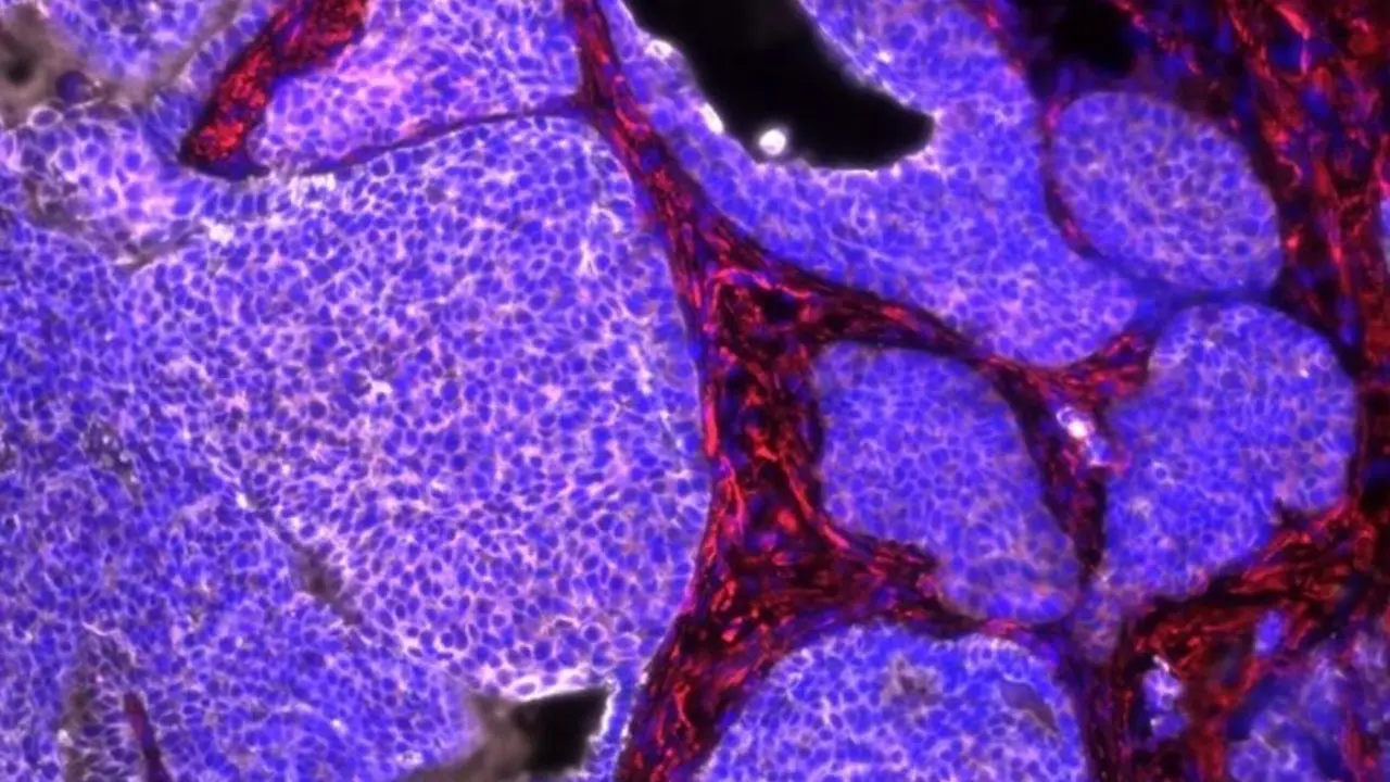  C&aacute;ncer de mama en rat&oacute;n, con c&eacute;lulas tumorales en color blanco 