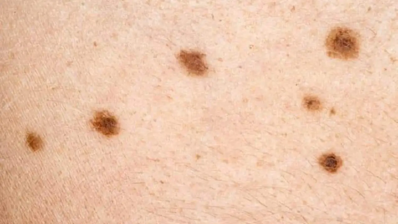  C&aacute;ncer de piel 