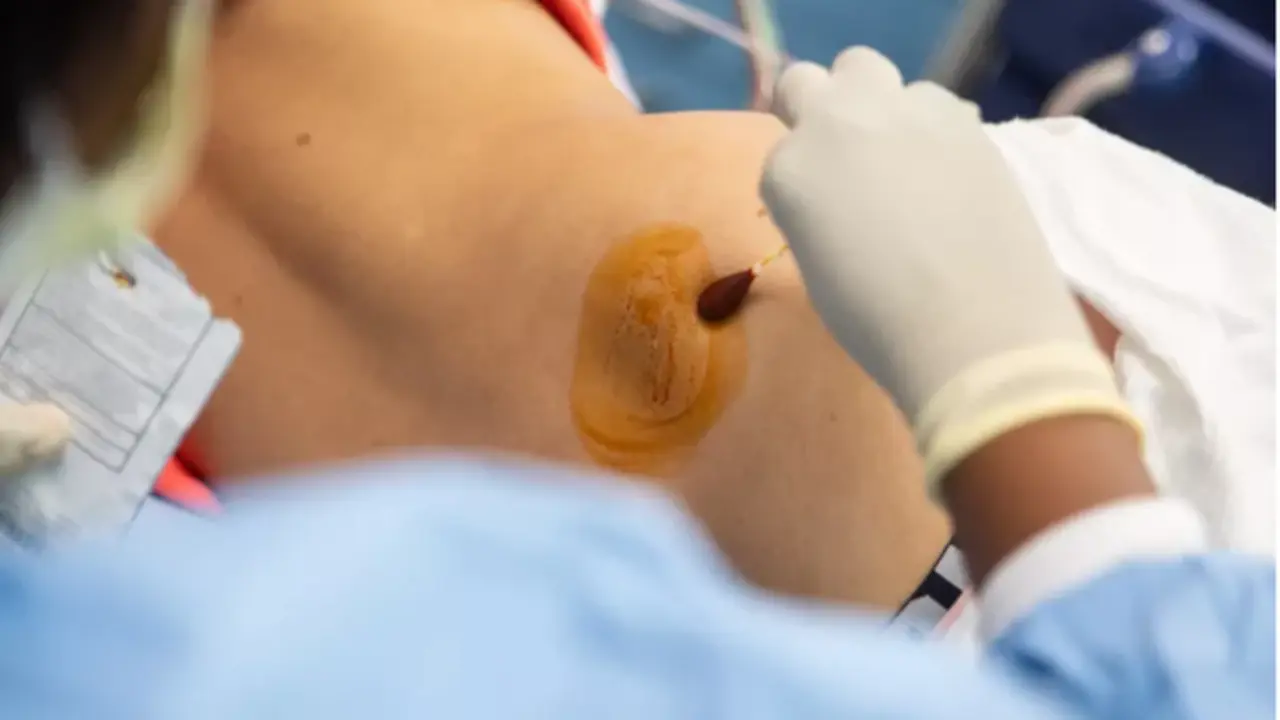  Biopsia de m&eacute;dula &oacute;sea 