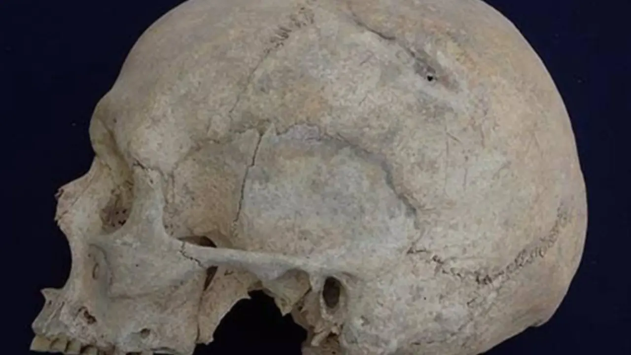  Cr&aacute;neo con fracturas 