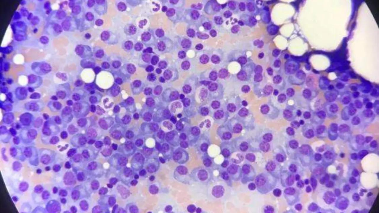 07-09-2021 Mieloma m&radic;&int;ltiple.
SALUD 
MD ANDERSON CANCER CENTER MADRID
