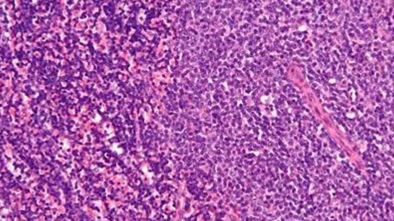  Leucemia linfoc&iacute;tica cr&oacute;nica 