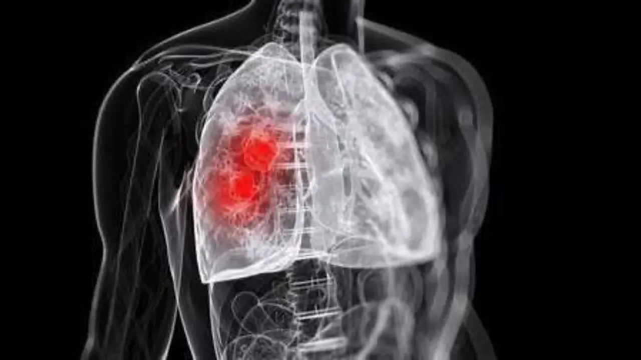  Pulm&oacute;n. ARCHIVO 