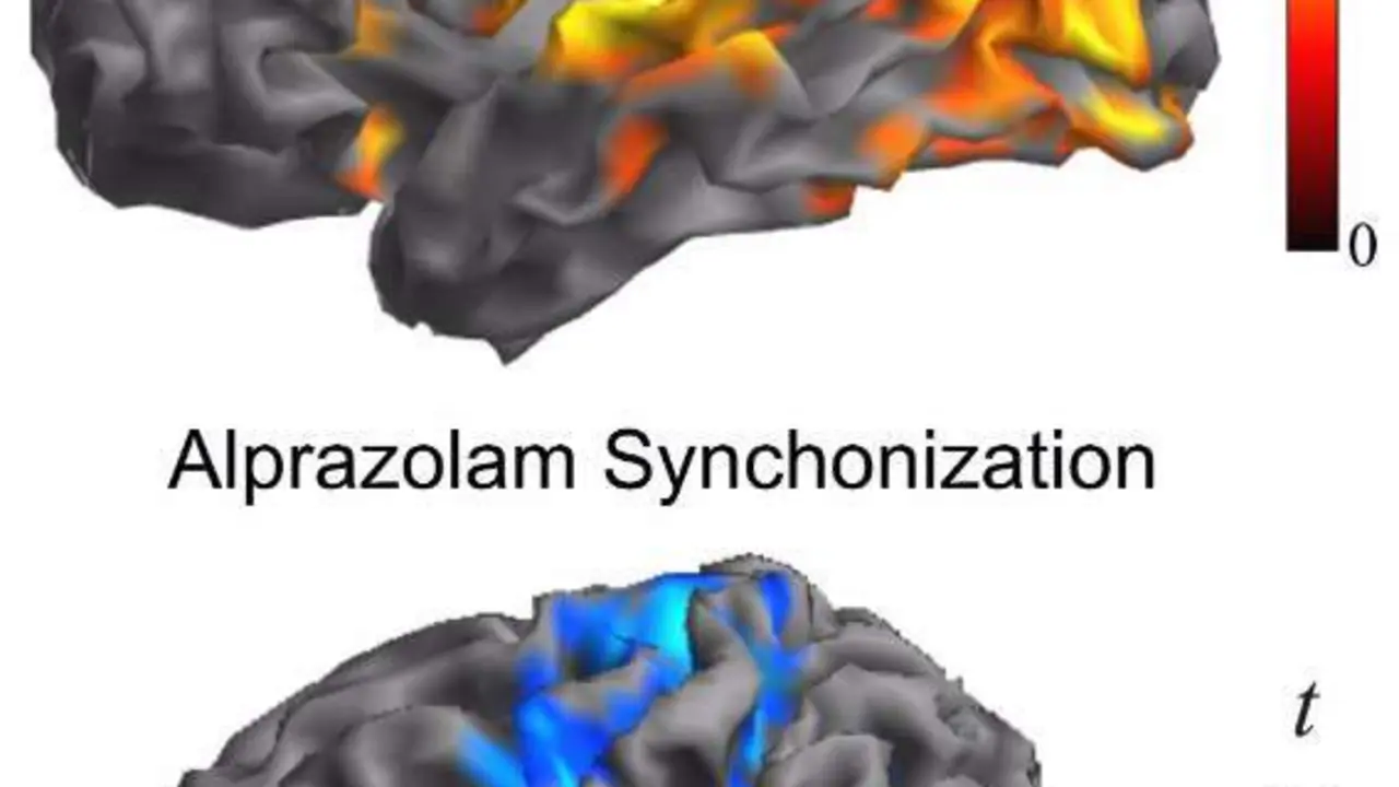  Imagen que muestra la similitud entre las &aacute;reas afectadas en el cerebro de una persona con esquizofrenia (figura superior) y las &aacute;reas donde se concentran las neuronas estudiadas (figura inferior) - HOSPITAL DEL MAR 
